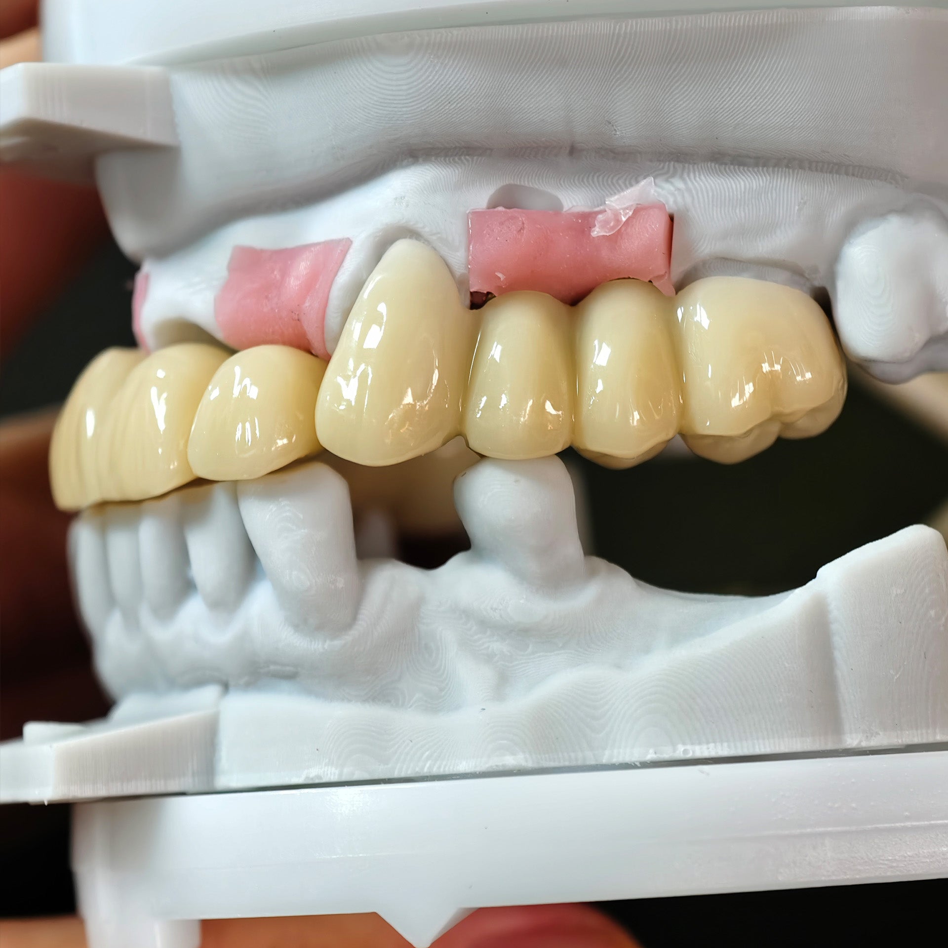 Zirconia Implant Bridge Screwmentable Dental Crown