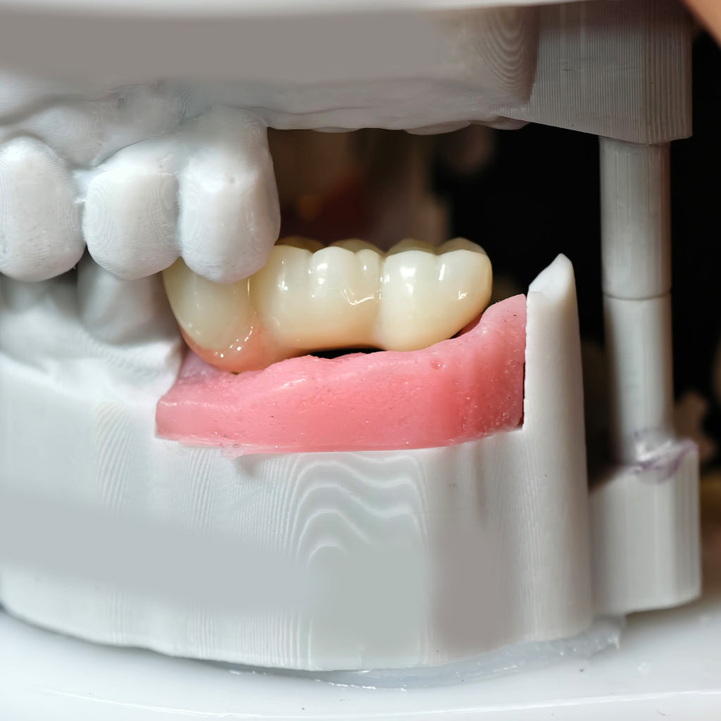 Zirconia Implant Bridge Screwmentable Dental Crown
