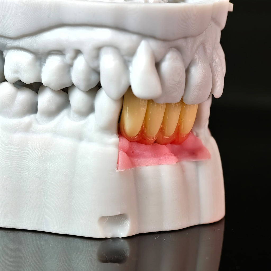 Zirconia Implant Bridge With Gold Plating