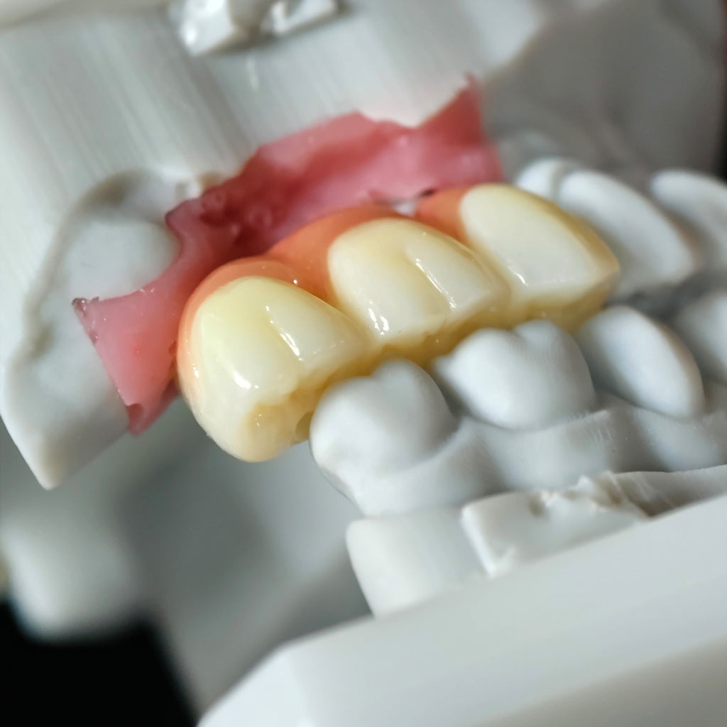 Zirconia Implant Crown Screwmentable Dental Crown