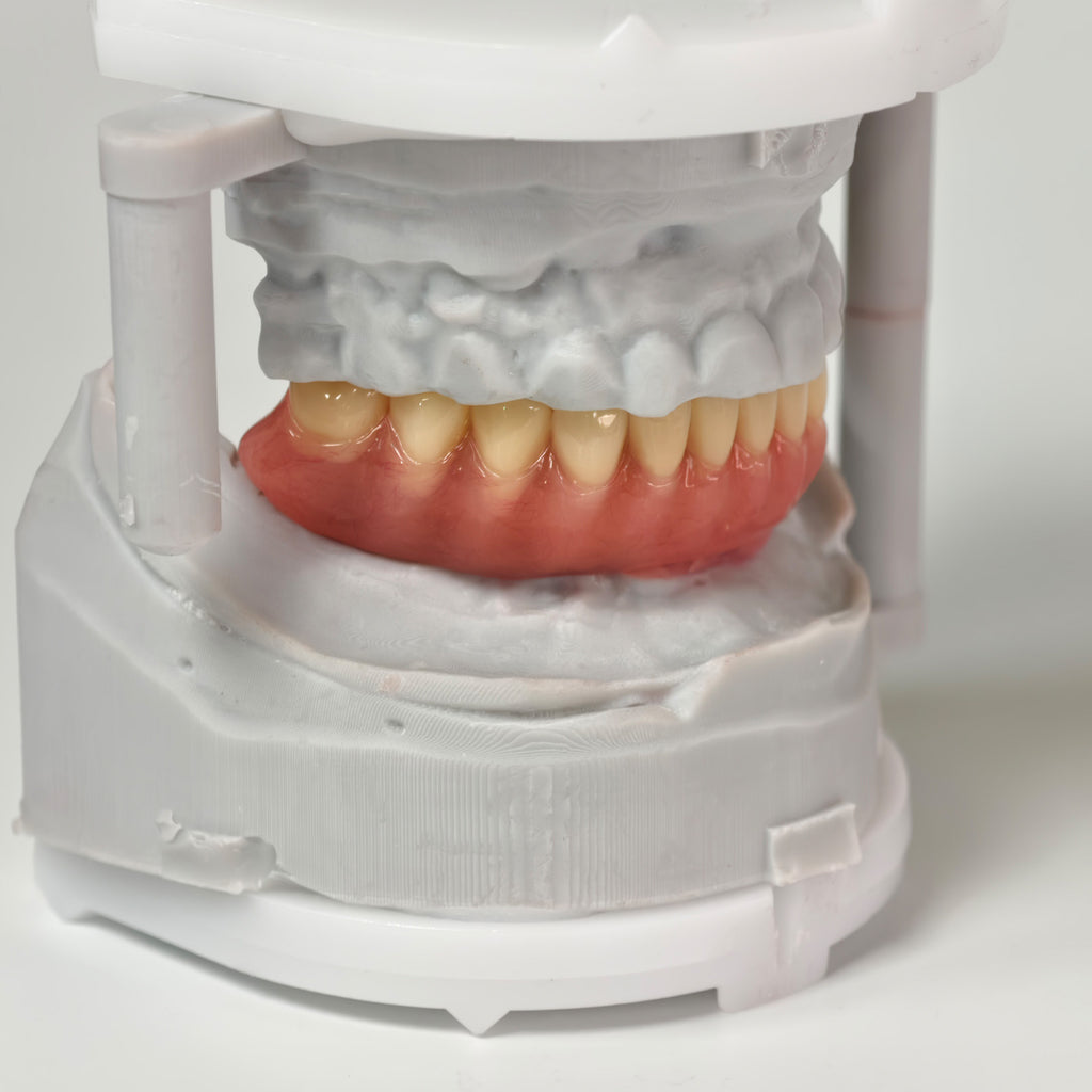 Acrylic Denture With Ti-Bar And Screw Retained