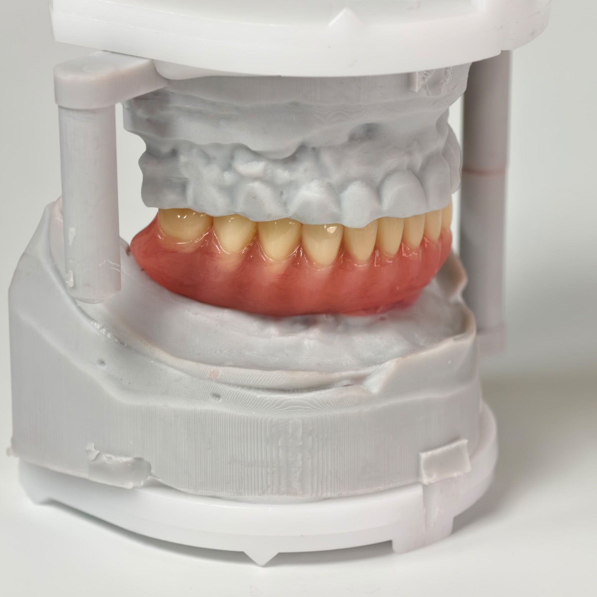 Acrylic Denture With Ti-Bar And Screw Retained