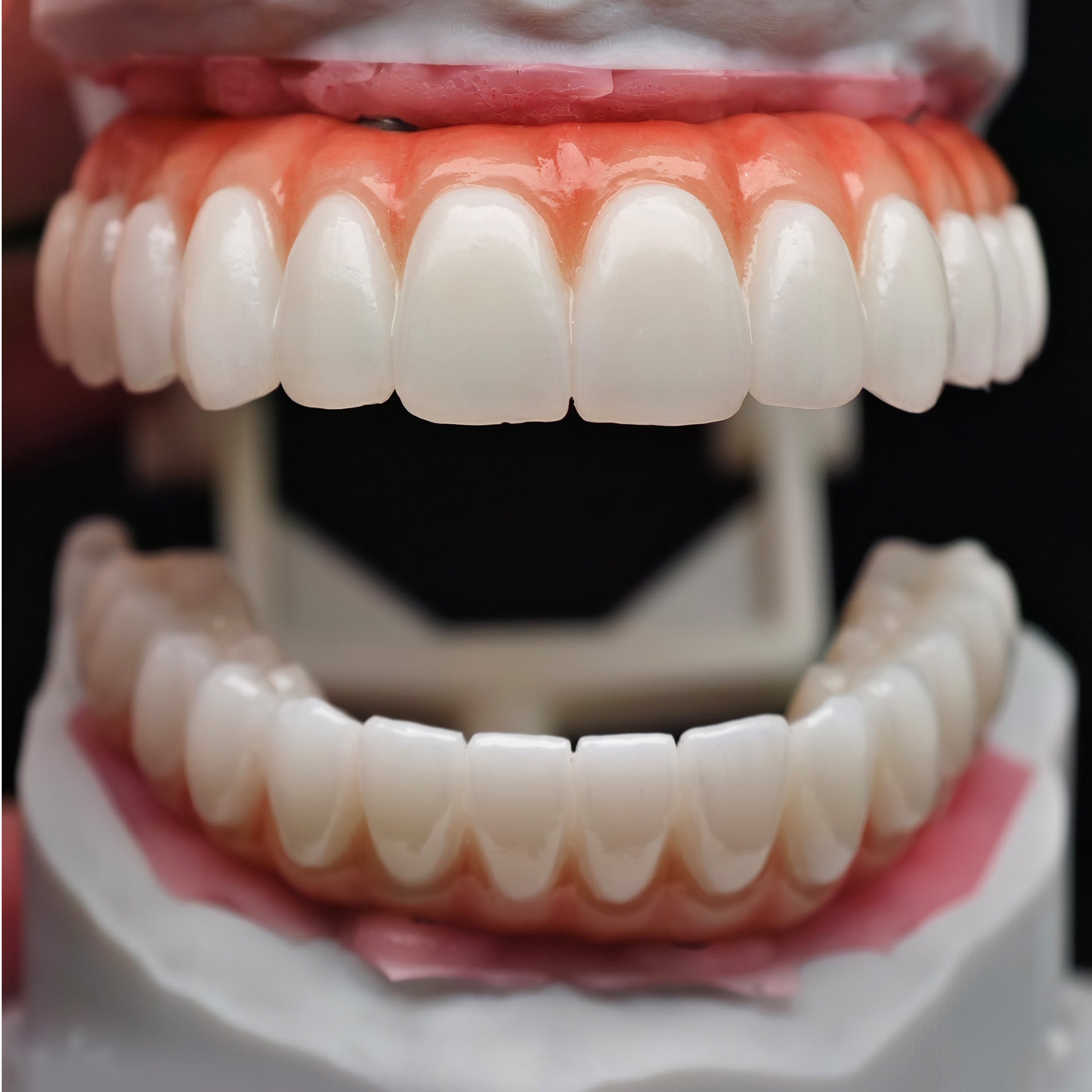 All On 4 Zirconia Bridge With Ti-Base Screw Retained Trying For Full Arch Restoration
