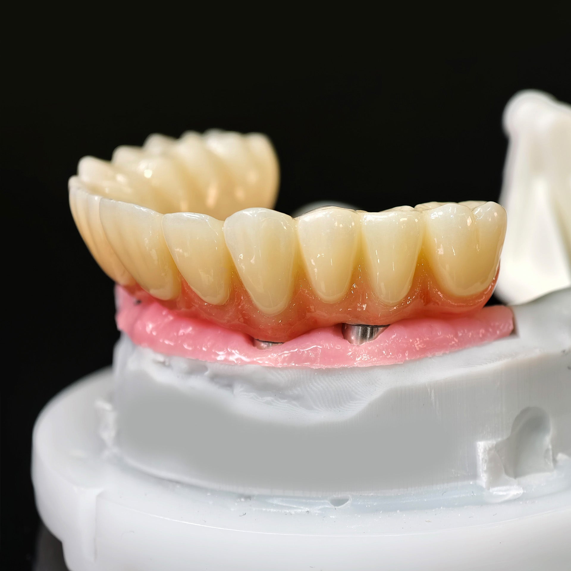 All On 5 Zirconia Bridge With Ti-Base Screw Retained Trying For Full Arch Restoration
