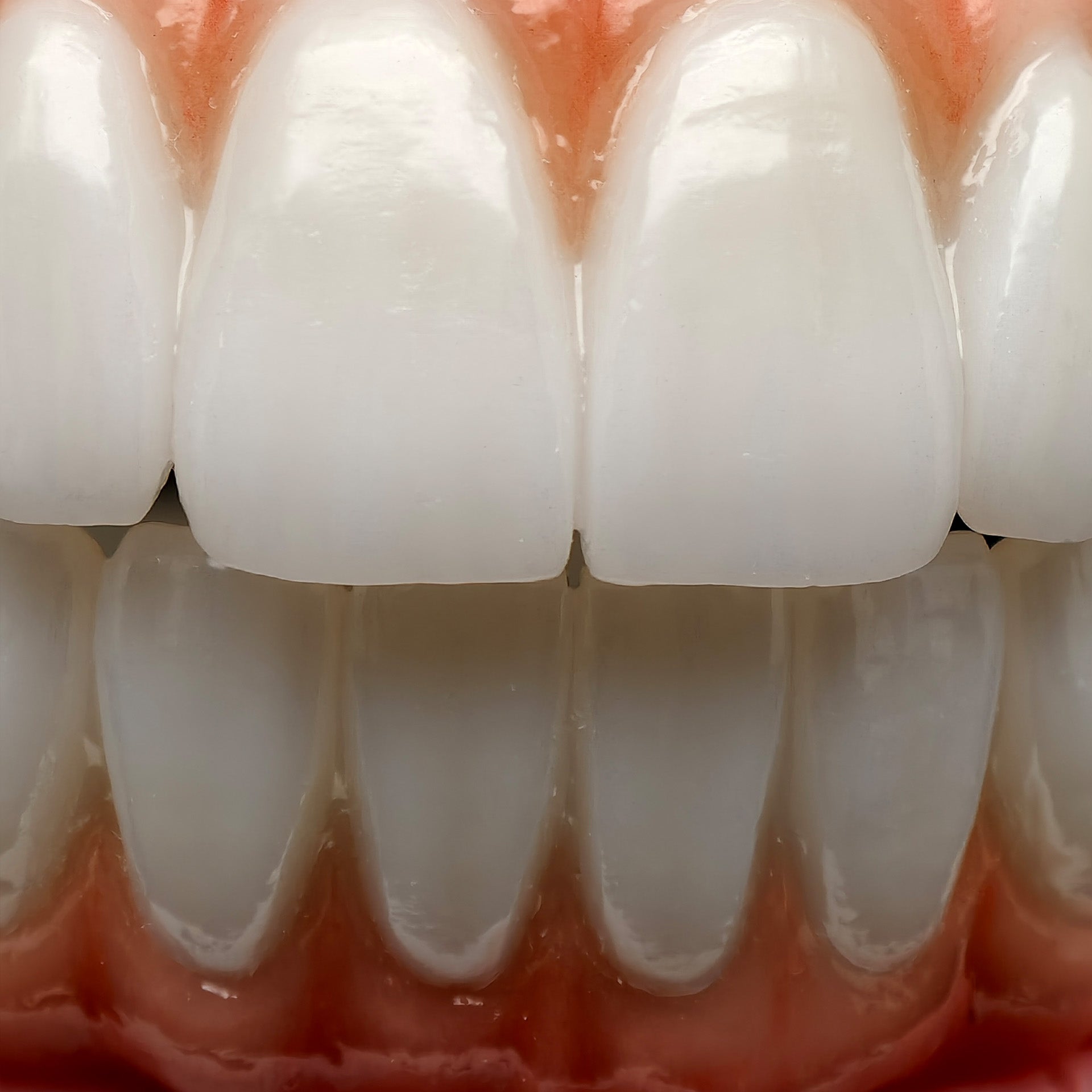 All On 5 Zirconia Bridge With Ti-Base Screw Retained Trying For Full Arch Restoration
