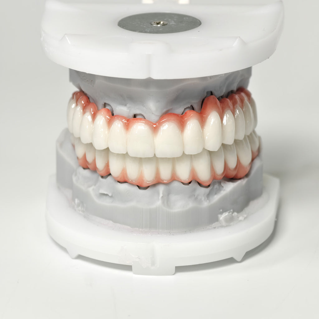 Full-Arch PFM Bridge With Screw Retained
