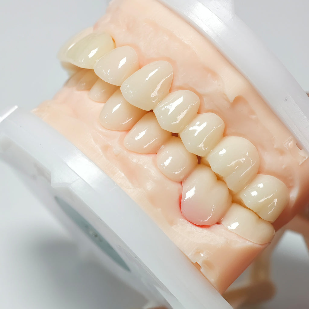 Full-Mouth Segmented PMMA Bridge With Cement Retained