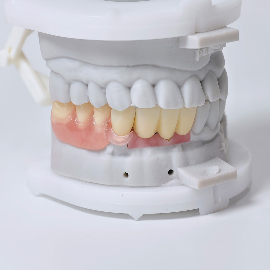 Full-Zirconia Crown And Bridge With Cement Retained And Co-Cr Frame Partial Denture