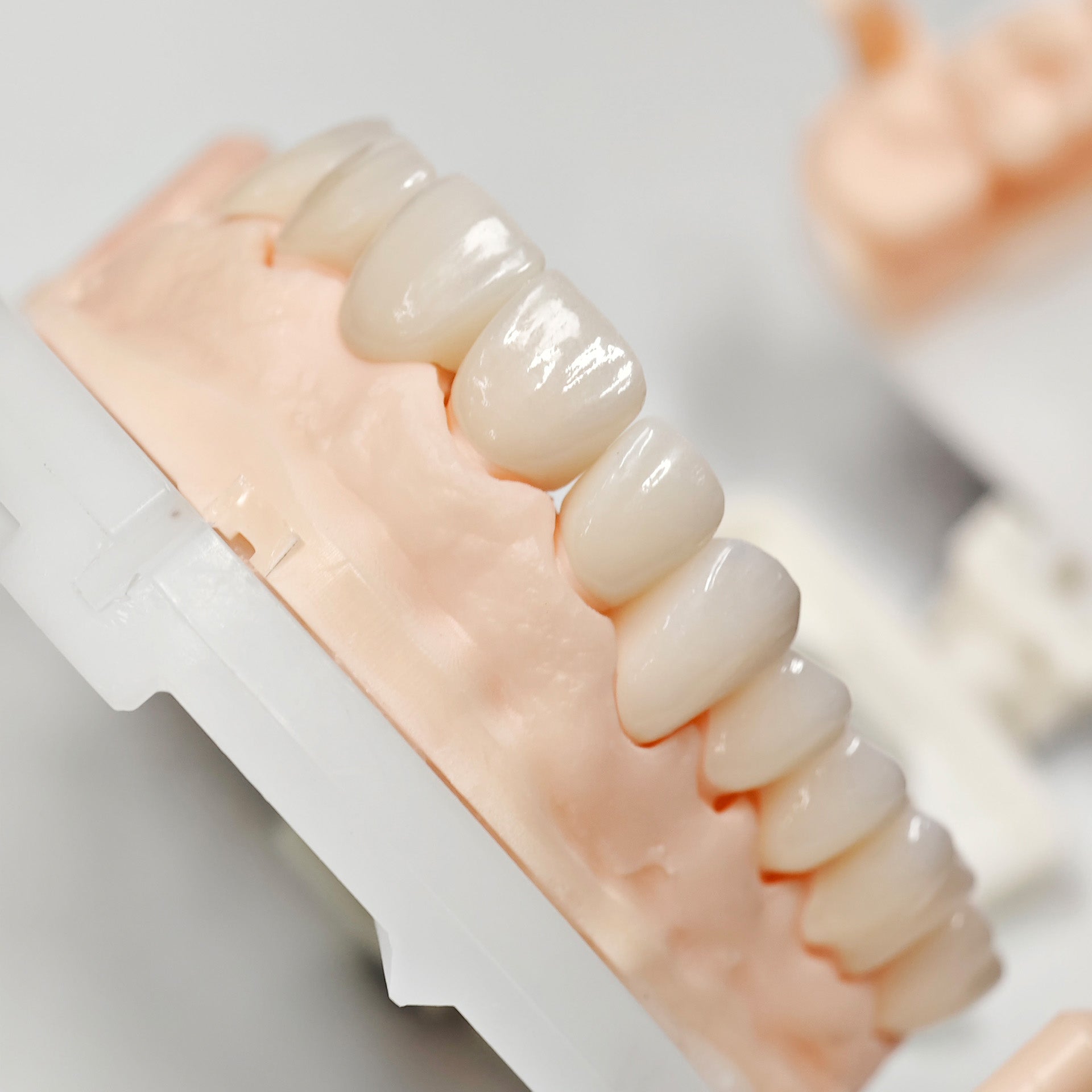 Full-Zriconia Crowns With Cement-Retained