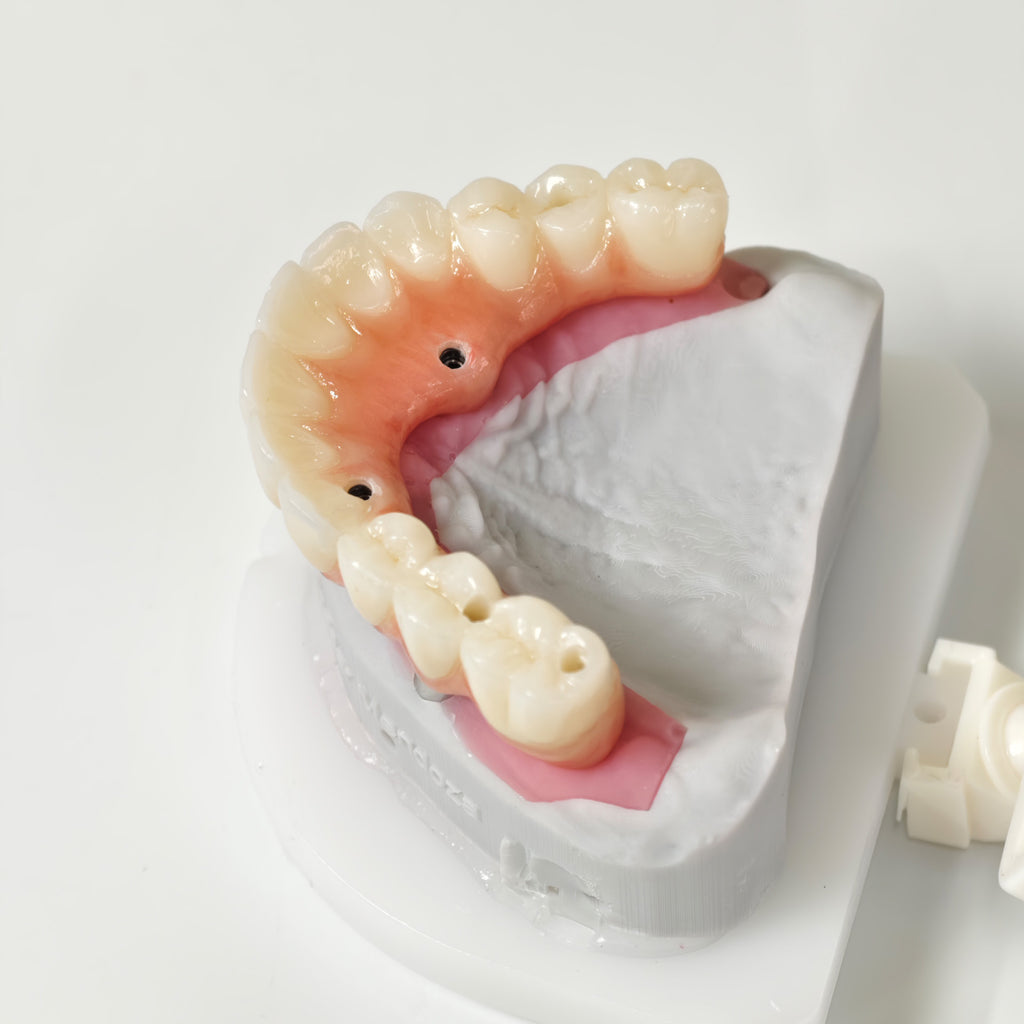 All On 5 Zirconia Bridge With Ti-Base Screw Retained