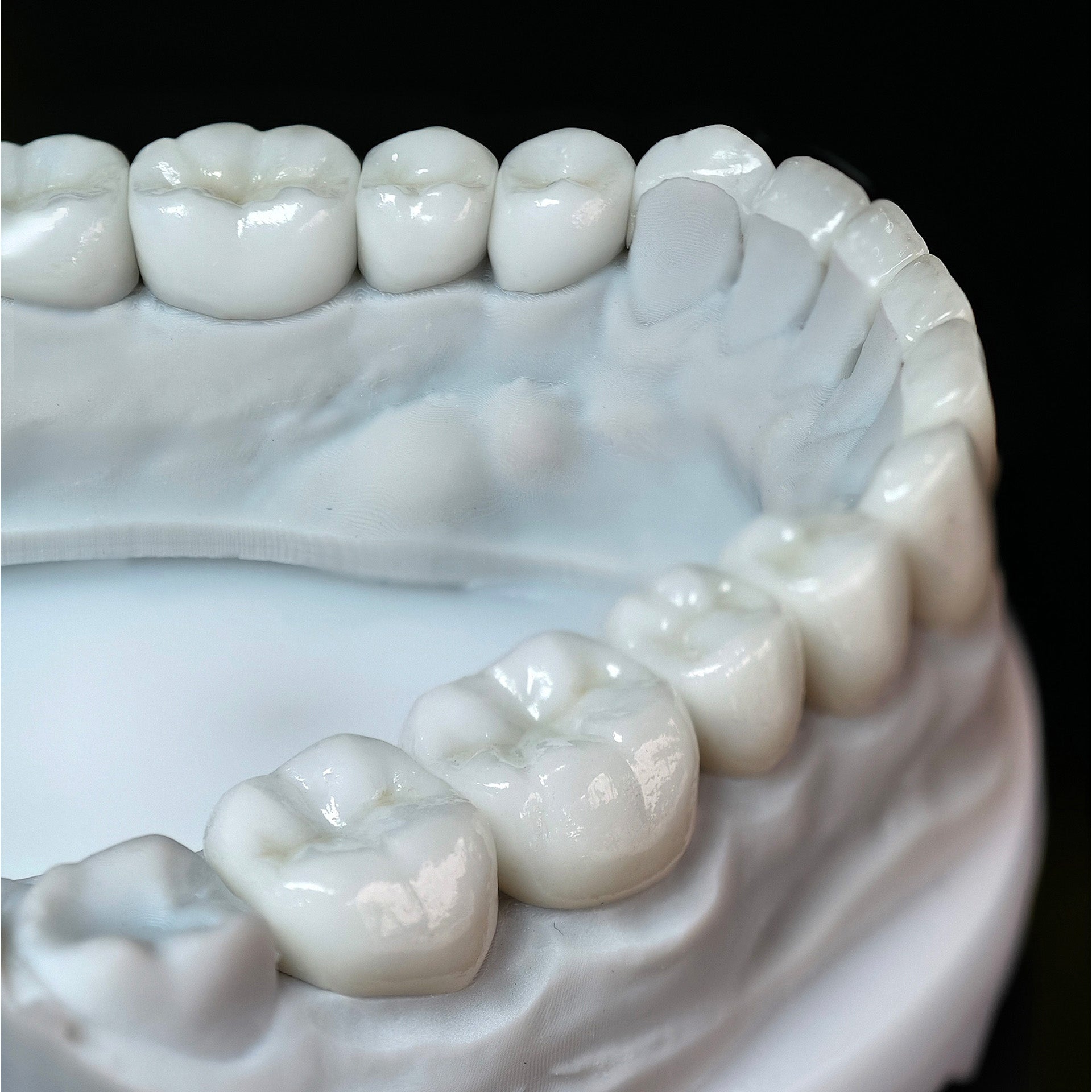 Ceramic Veneers And Crown With Cement Retained
