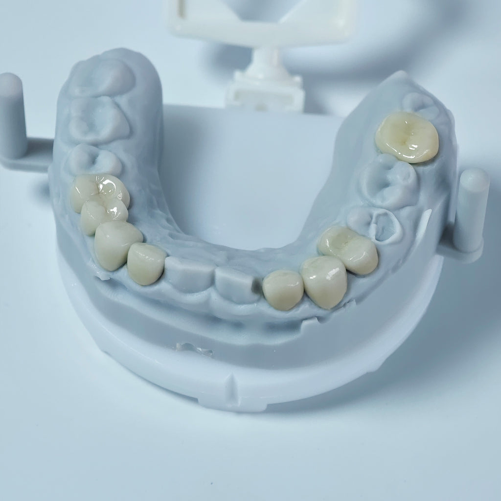 Co - Cr PFM Dental Crowns With Metal Post-And-Core