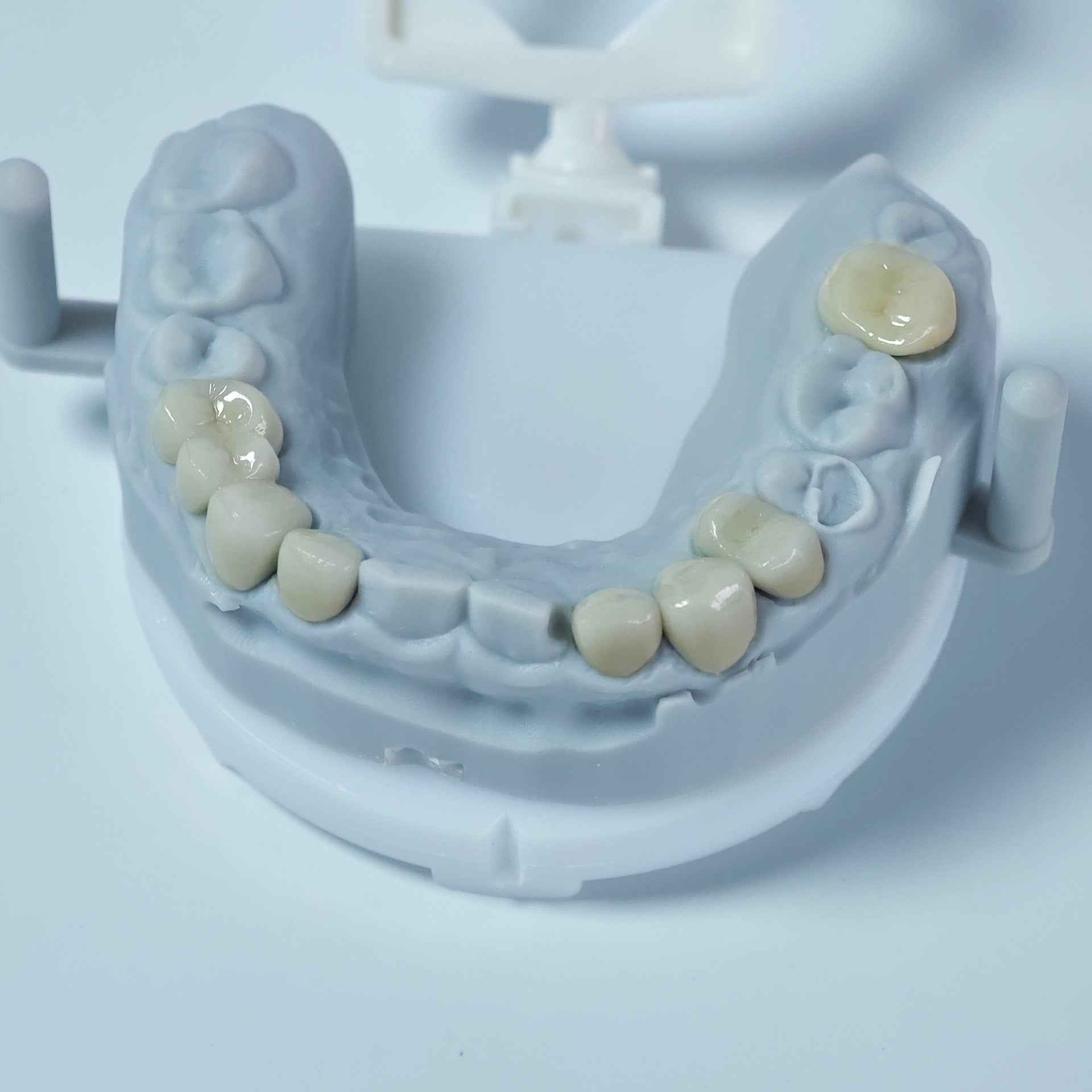 Co - Cr PFM Dental Crowns With Metal Post-And-Core