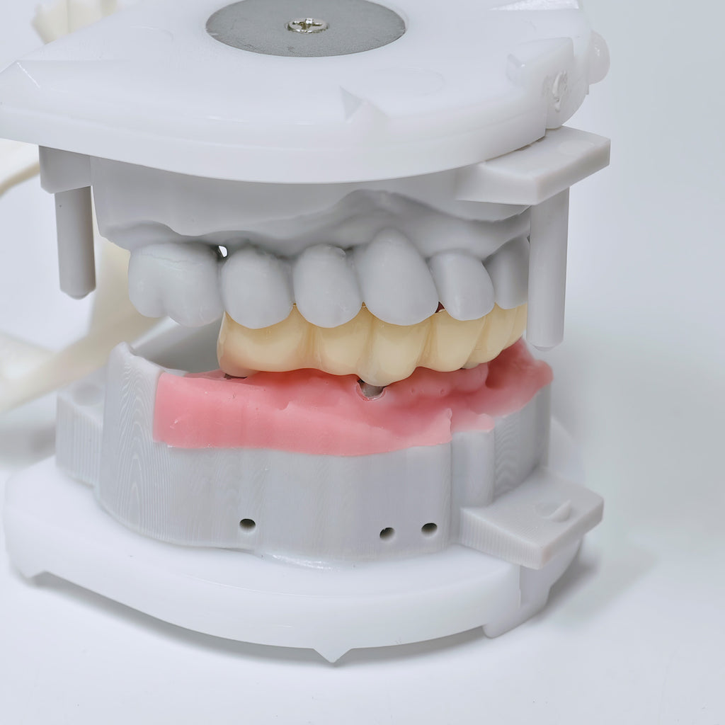 Custom Abutment And PMMA Bridge With Cement Retained And Implant Seating Guide