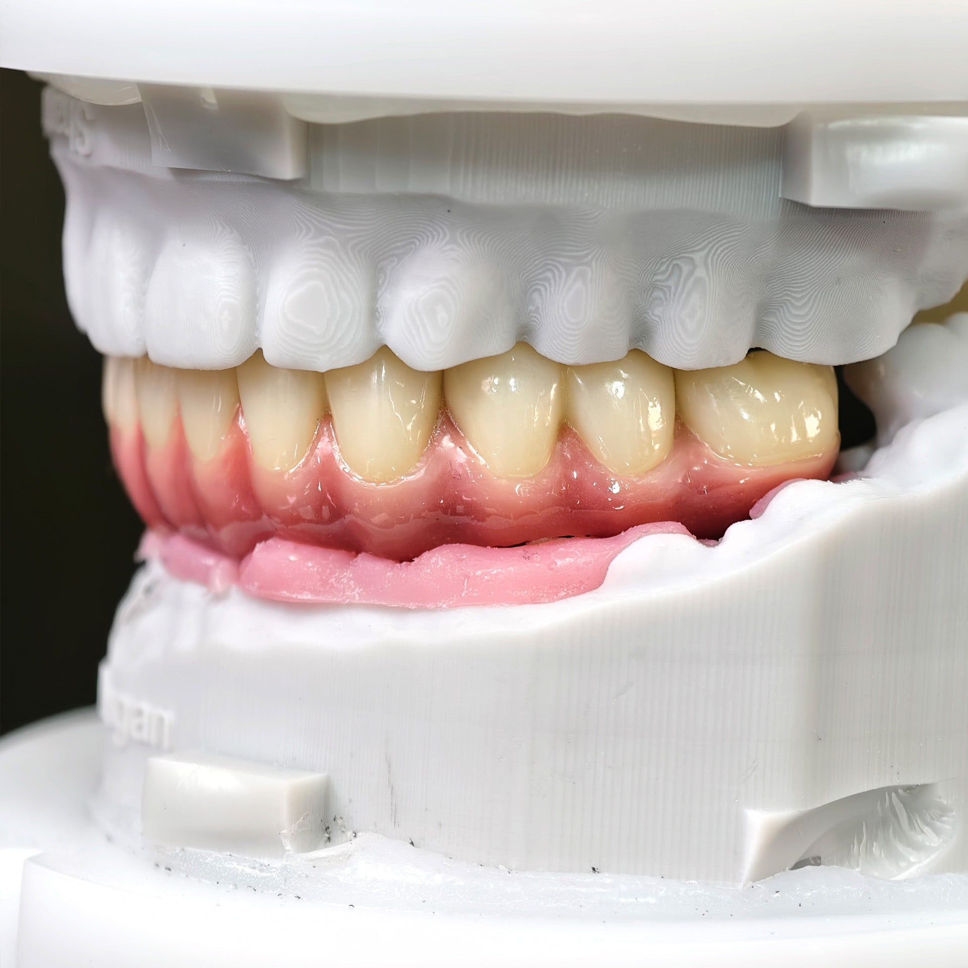 Enhanced Zirconia Crown Malo Bridge