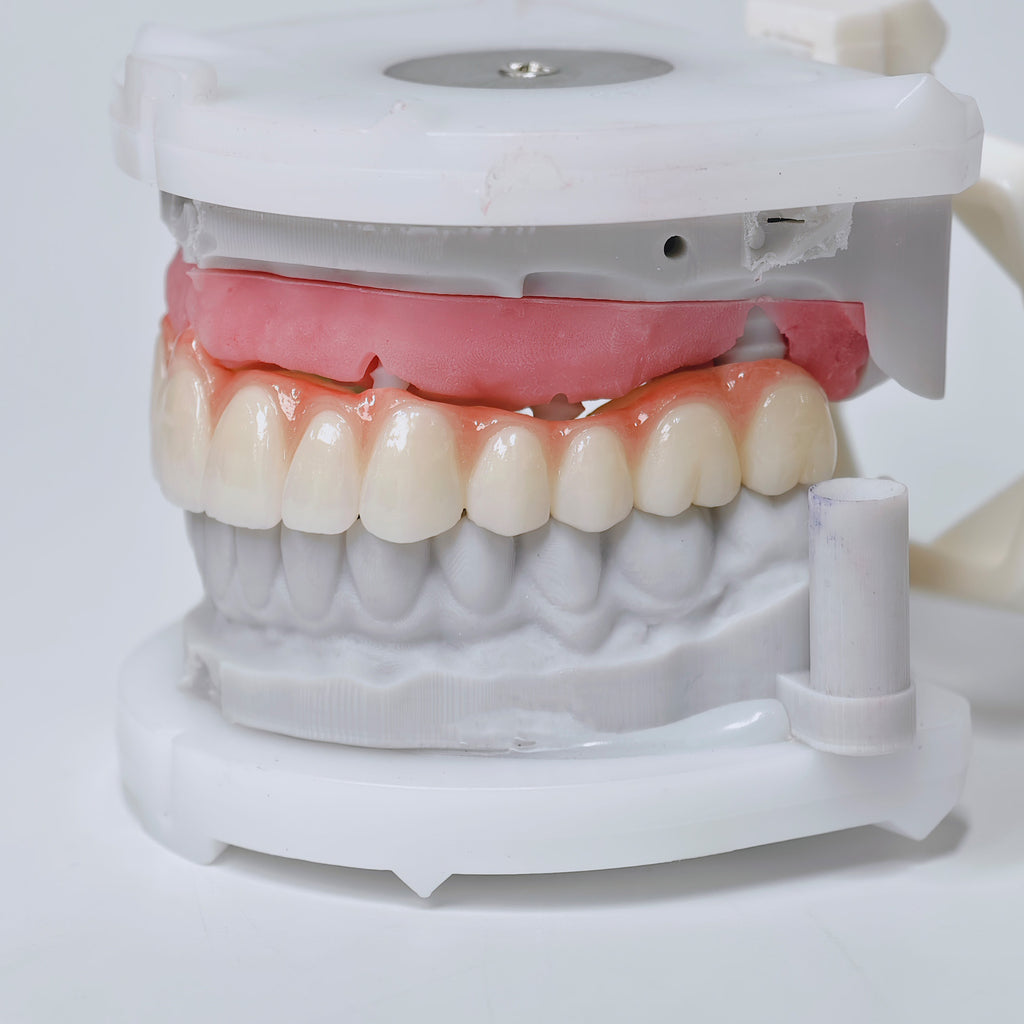 Half-Mouth Zirconia Bridge With Cement-Retained
