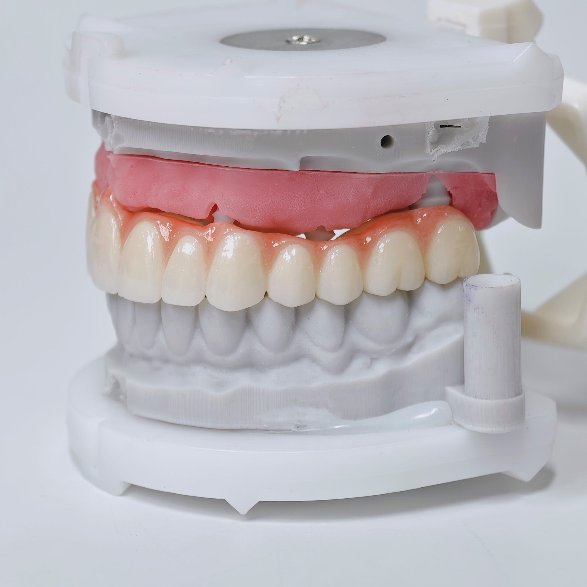 Half-Mouth Zirconia Bridge With Cement-Retained