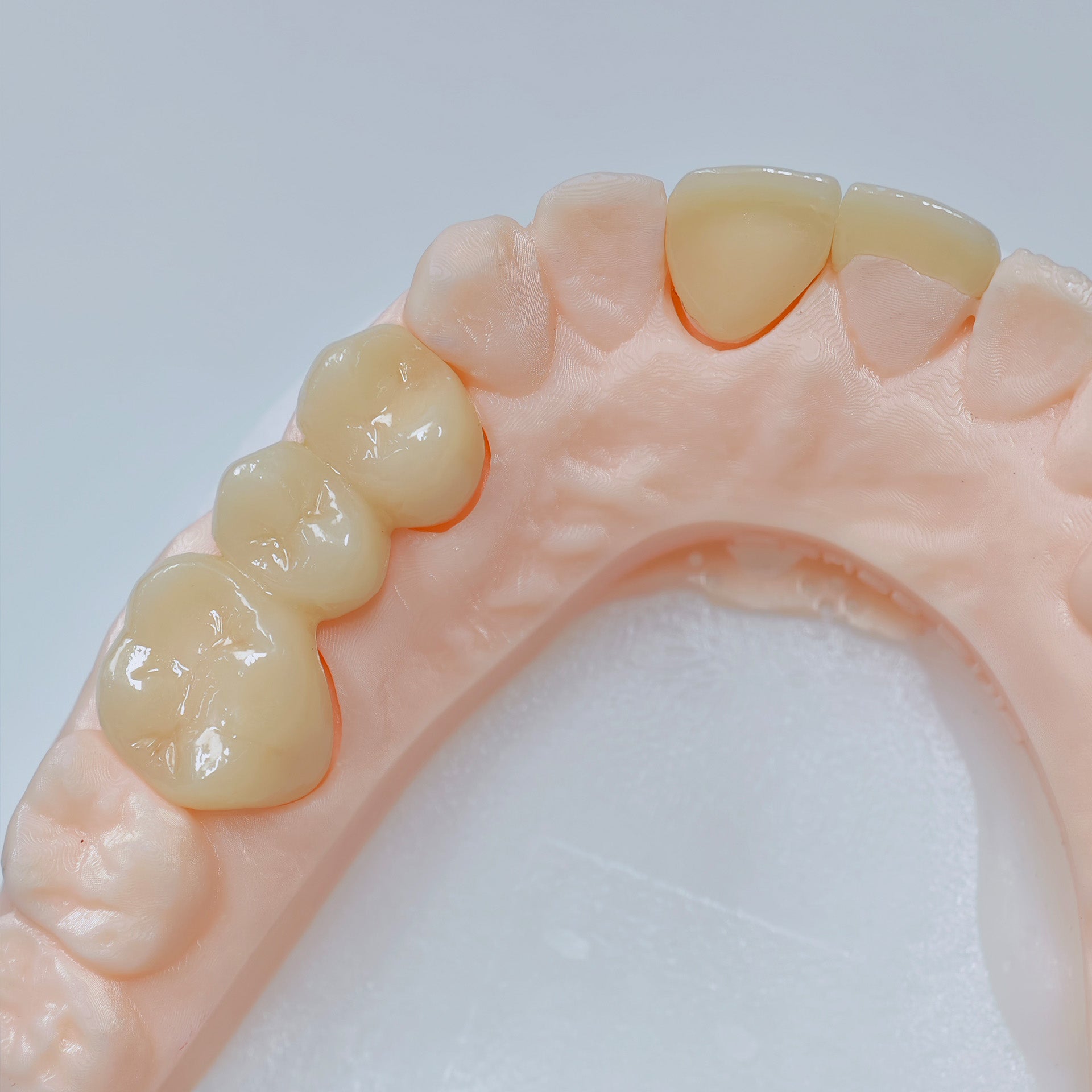 High - Strength Zirconia Crowns