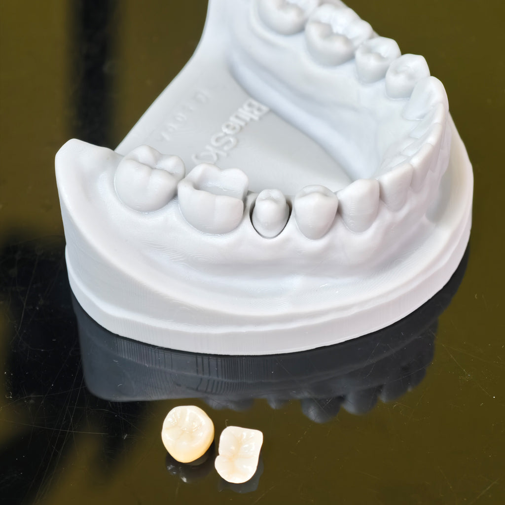 High - Strength Zirconia Inlay And Crown