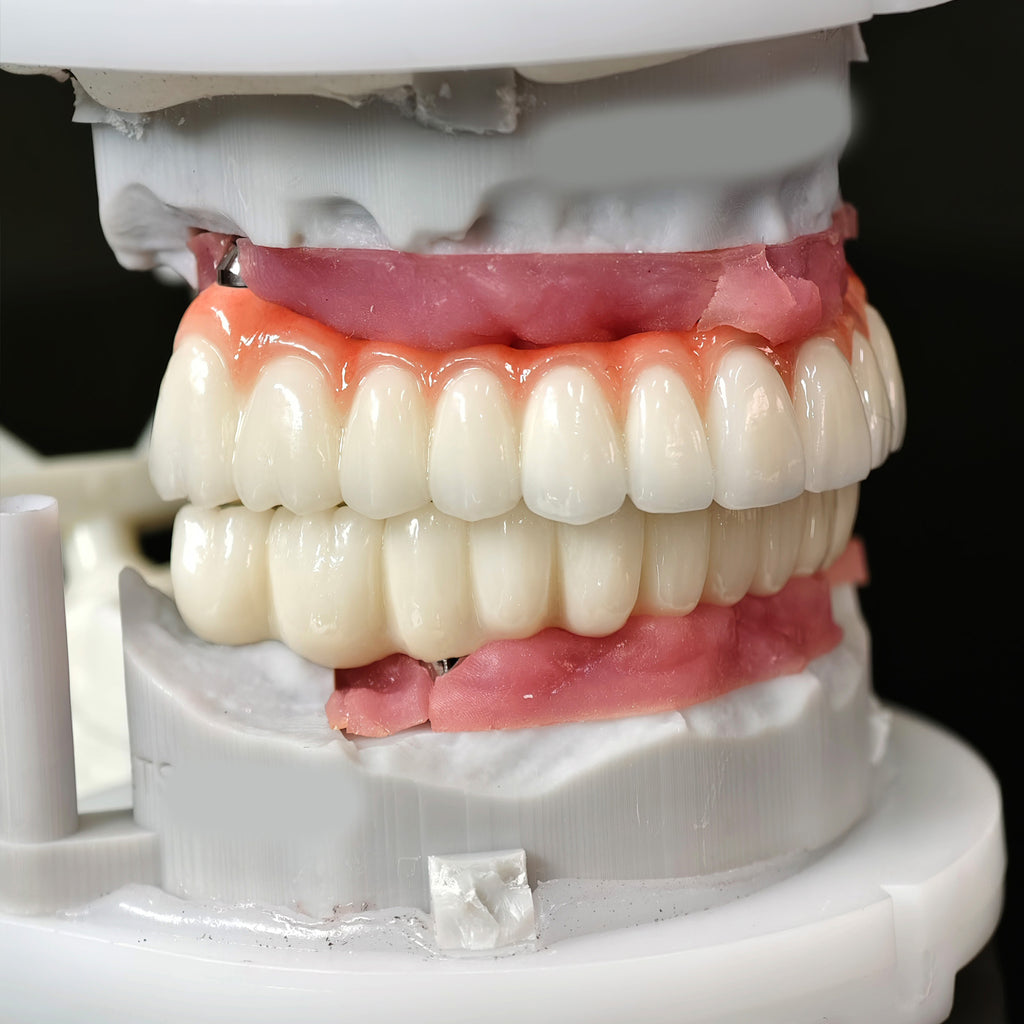 Implant-supported Co - Cr PFM Dental Bridge