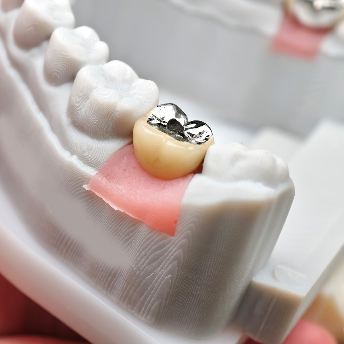 Implant-Supported PFM Single Crown With Metal