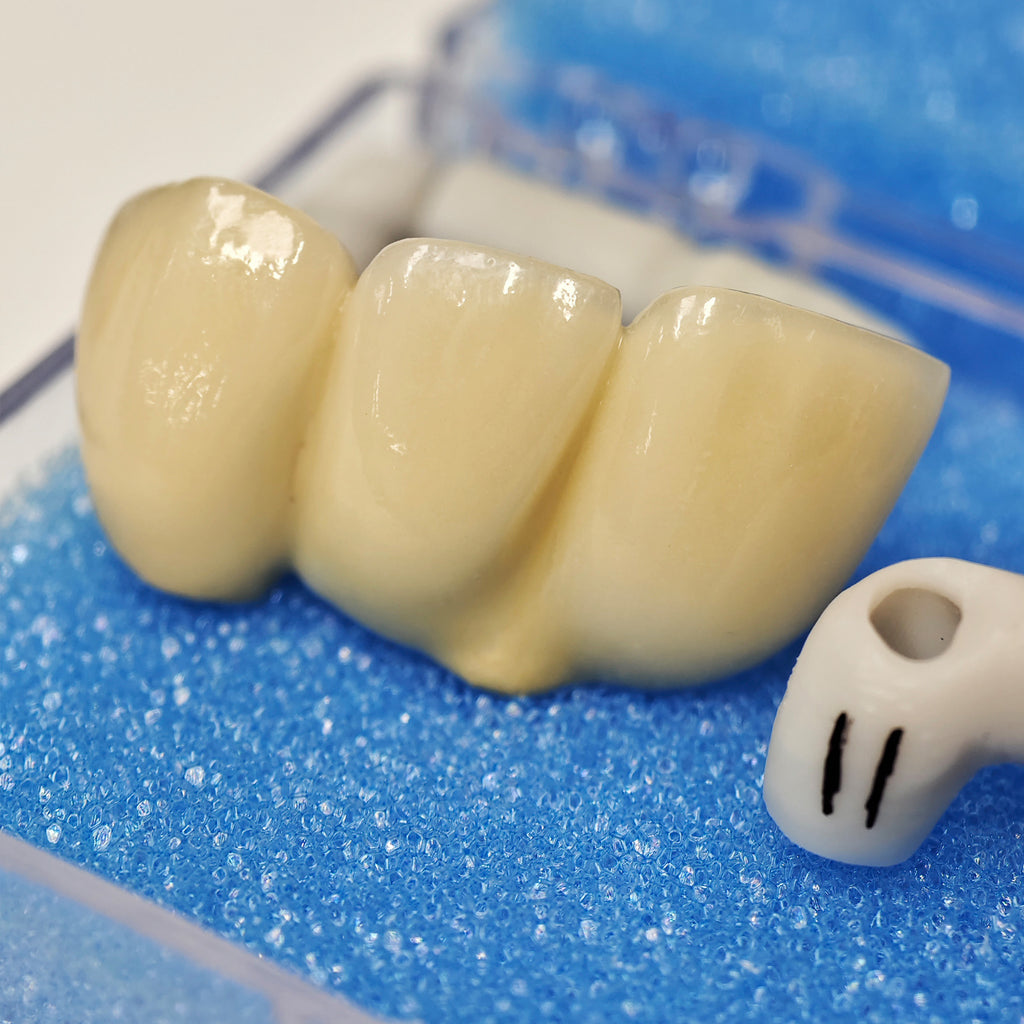 PFM Bridge With Screw-Retained And Implant Seating Guide