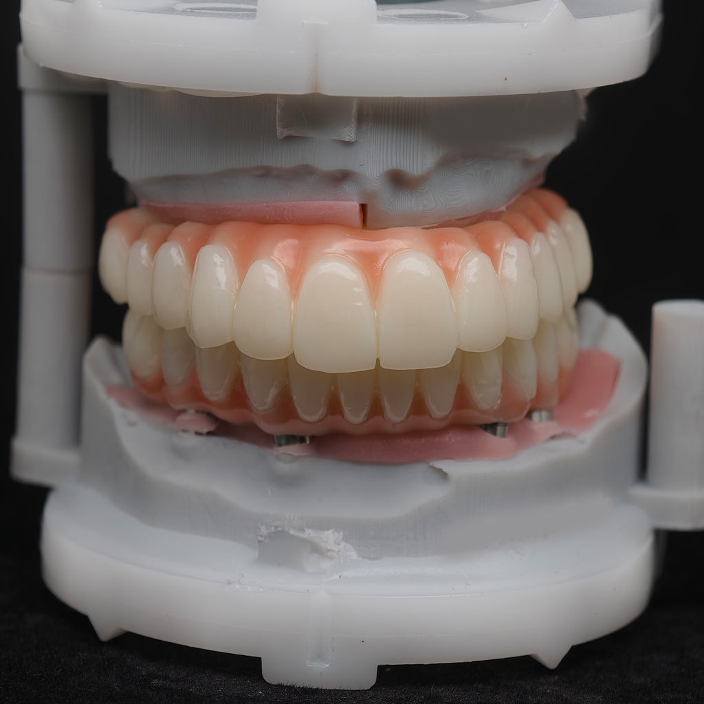 PMMA Bridge With Ti-Base Screw Retained Trying For Full Arch Restoration