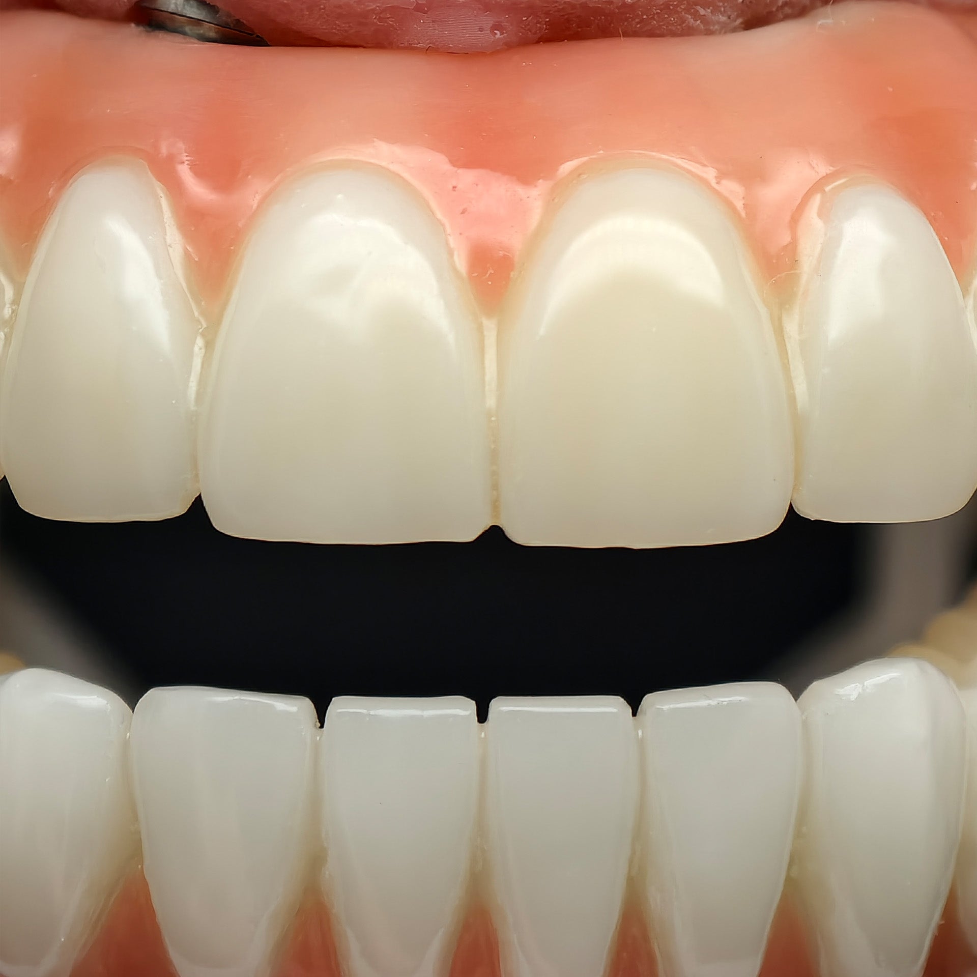 PMMA Bridge With Ti-Base Screw Retained Trying For Full Arch Restoration