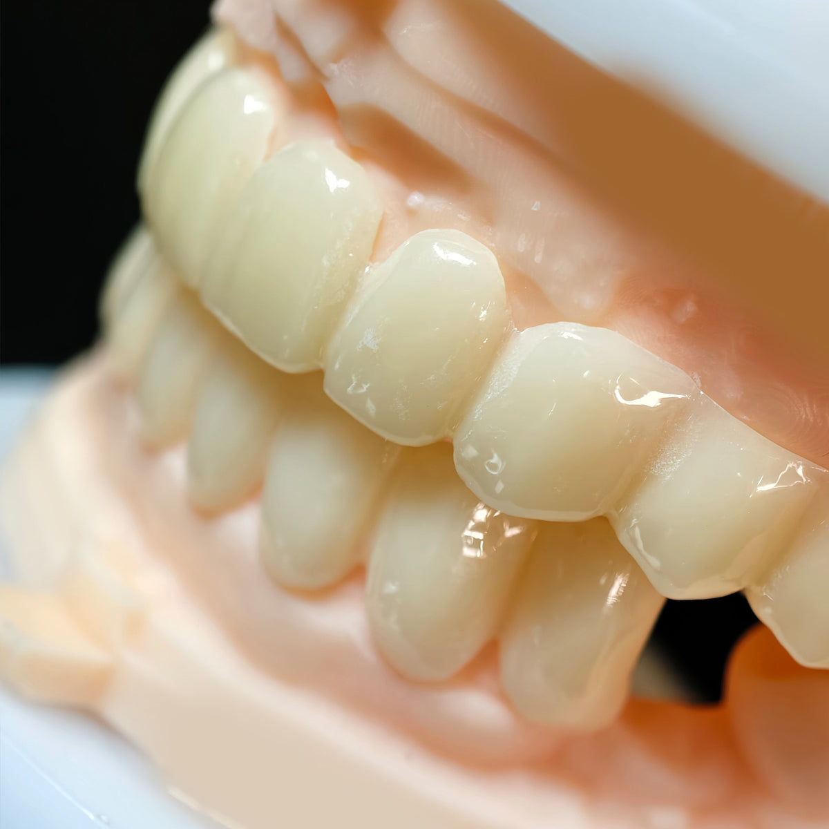 PMMA Bridge With Open Shell Preparing For Full Arch Dental Implants