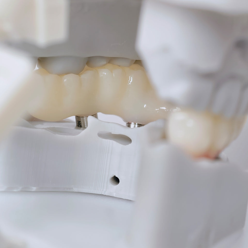 PMMA Bridge With Screw Retained