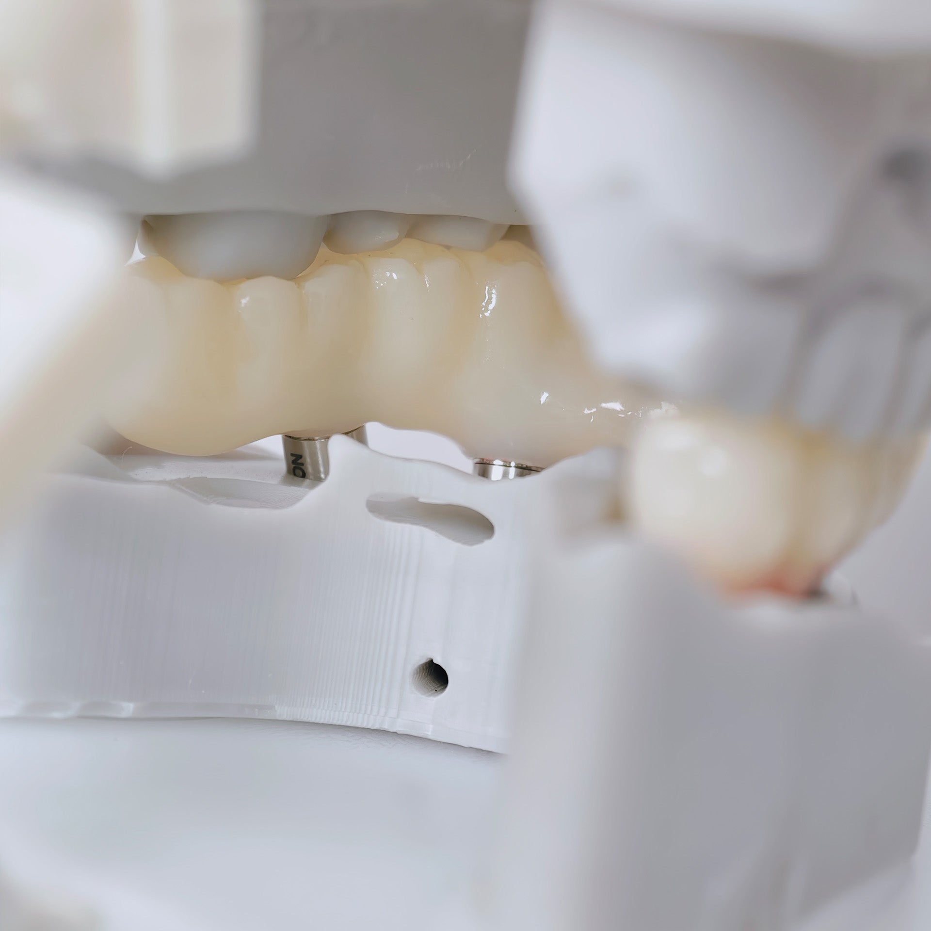 PMMA Bridge With Screw Retained