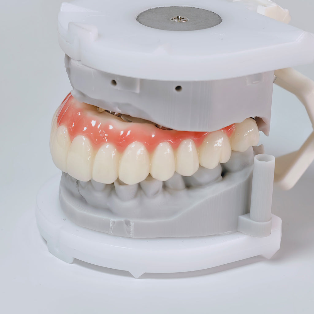 PMMA Bridge With Screw Retained