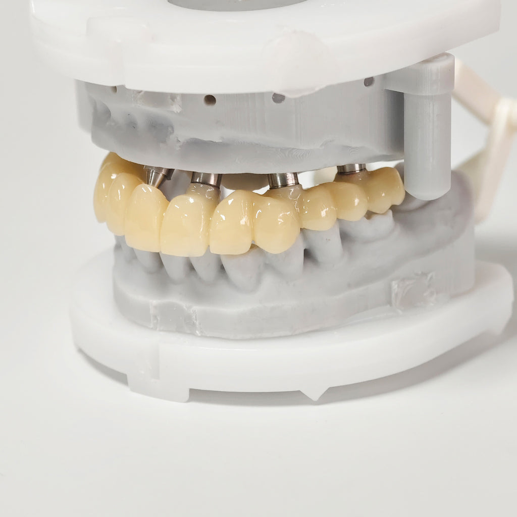 PMMA Bridge With Screw Retained