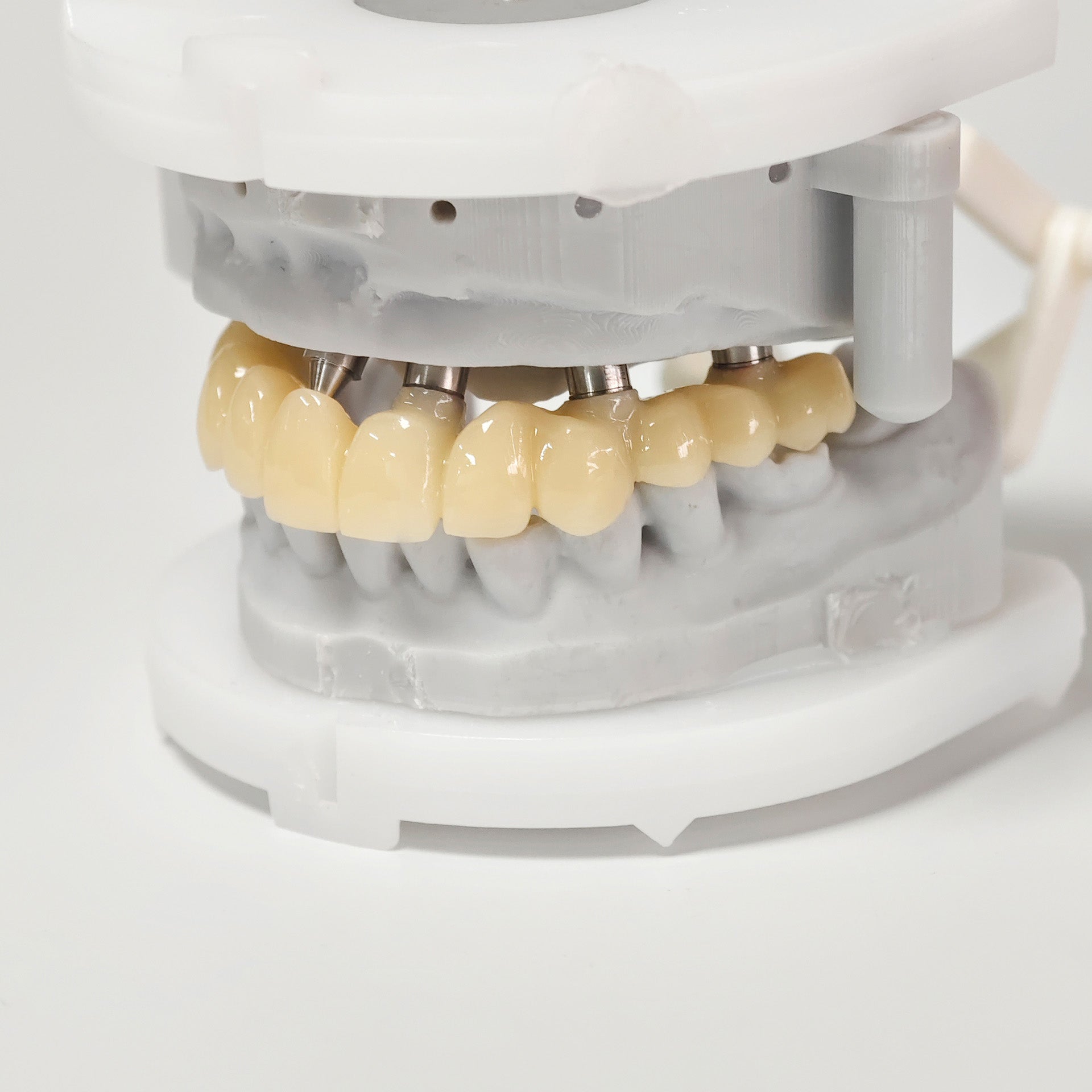PMMA Bridge With Screw Retained