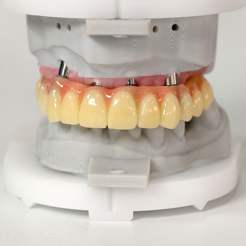 PMMA Bridge With Screw Retained