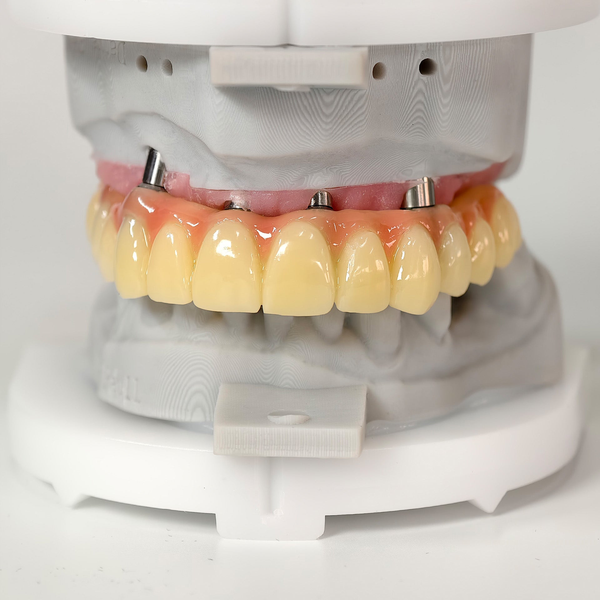 PMMA Bridge With Screw Retained