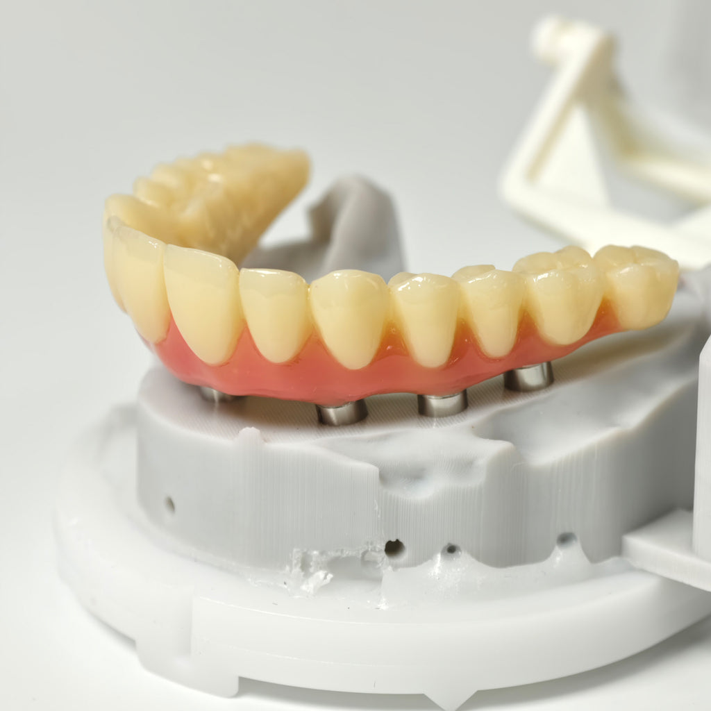 PMMA Bridge With Screw Retained
