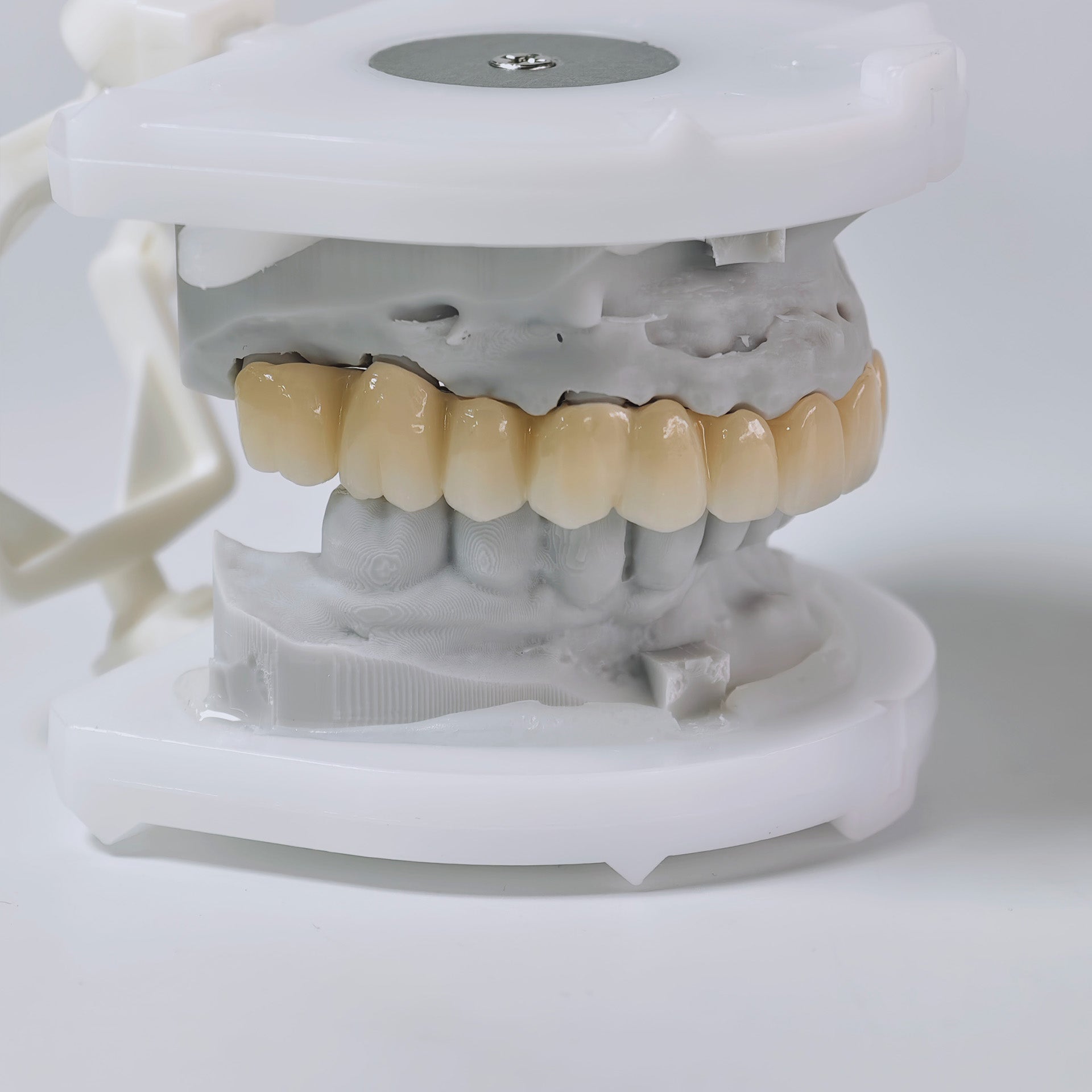 Ti-Bar Titanium Nitride Metal Frame With Zirconia Bridge And Cement Retained