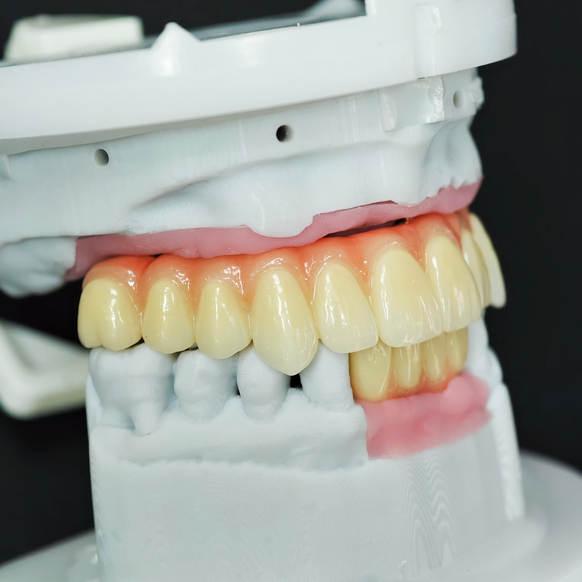 Ti-Bar Titanium Nitride Metal Frame With Zirconia Bridge For Full Arch Restoration