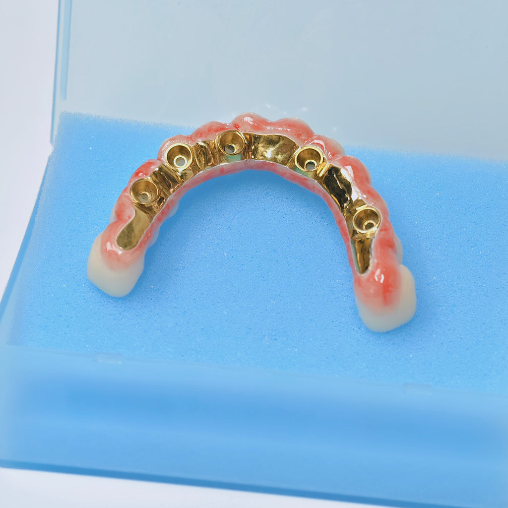 Ti-Bar Titanium Nitride Metal Frame With Zirconia Bridge For Full Arch Restoration
