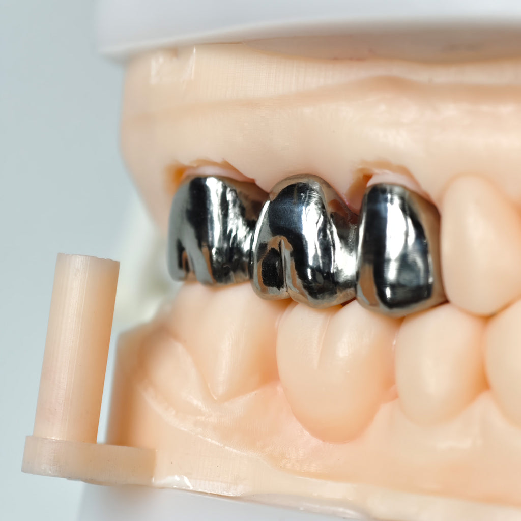 Titanium Crown With Cement Retained