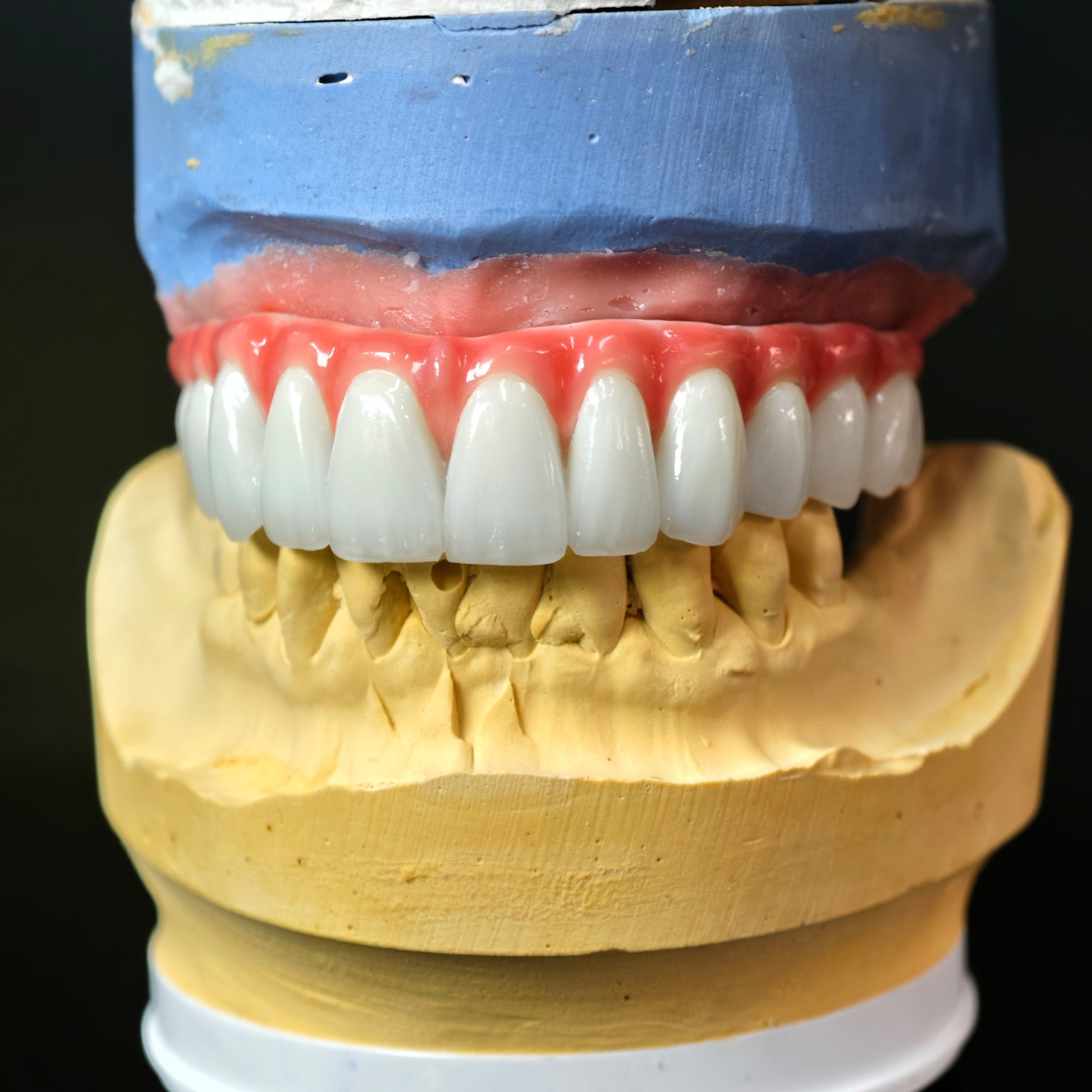 Traditional Malo Bridge With Alloy Framework Covering The Gingiva