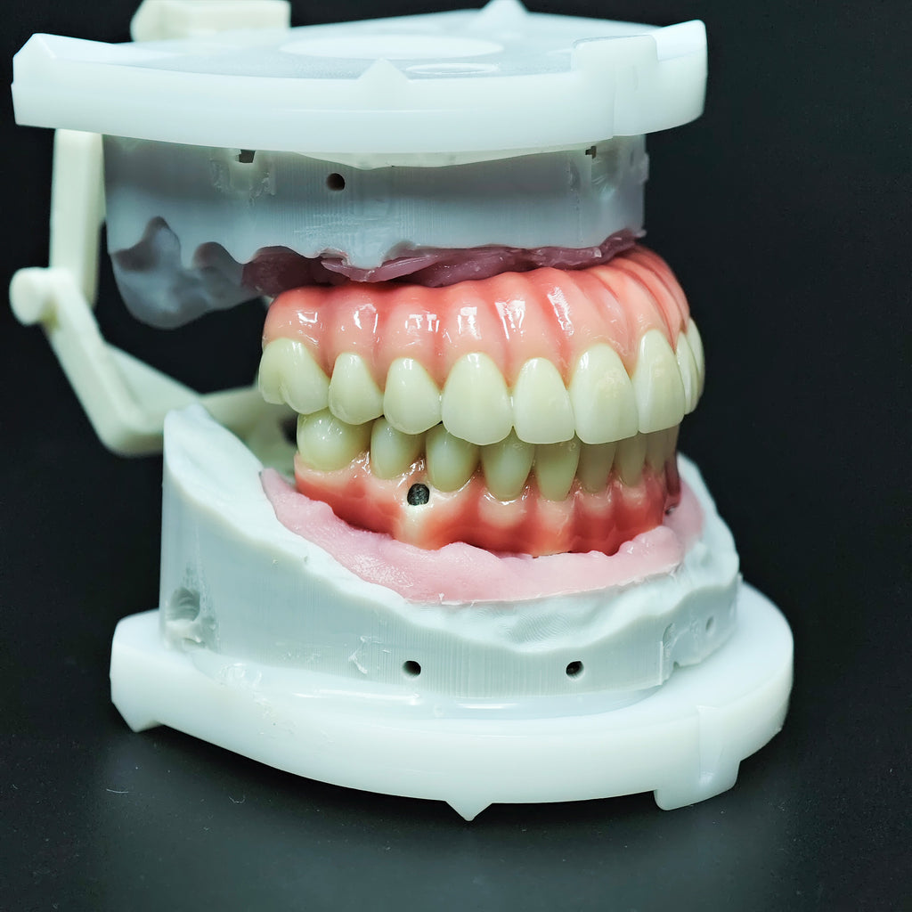 Zirconia-Enamel Hybrid Malo Bridge