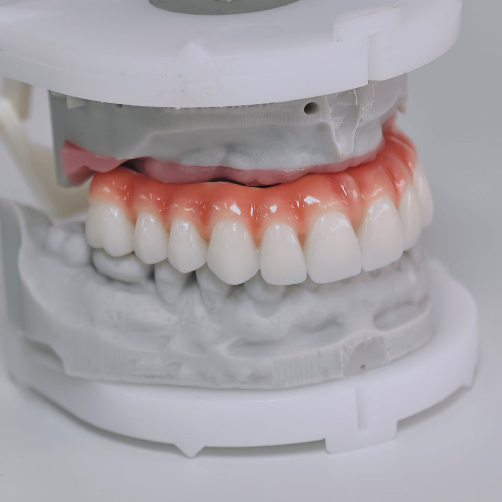 Zirconia-Enamel Hybrid Malo Bridge Aesthetic