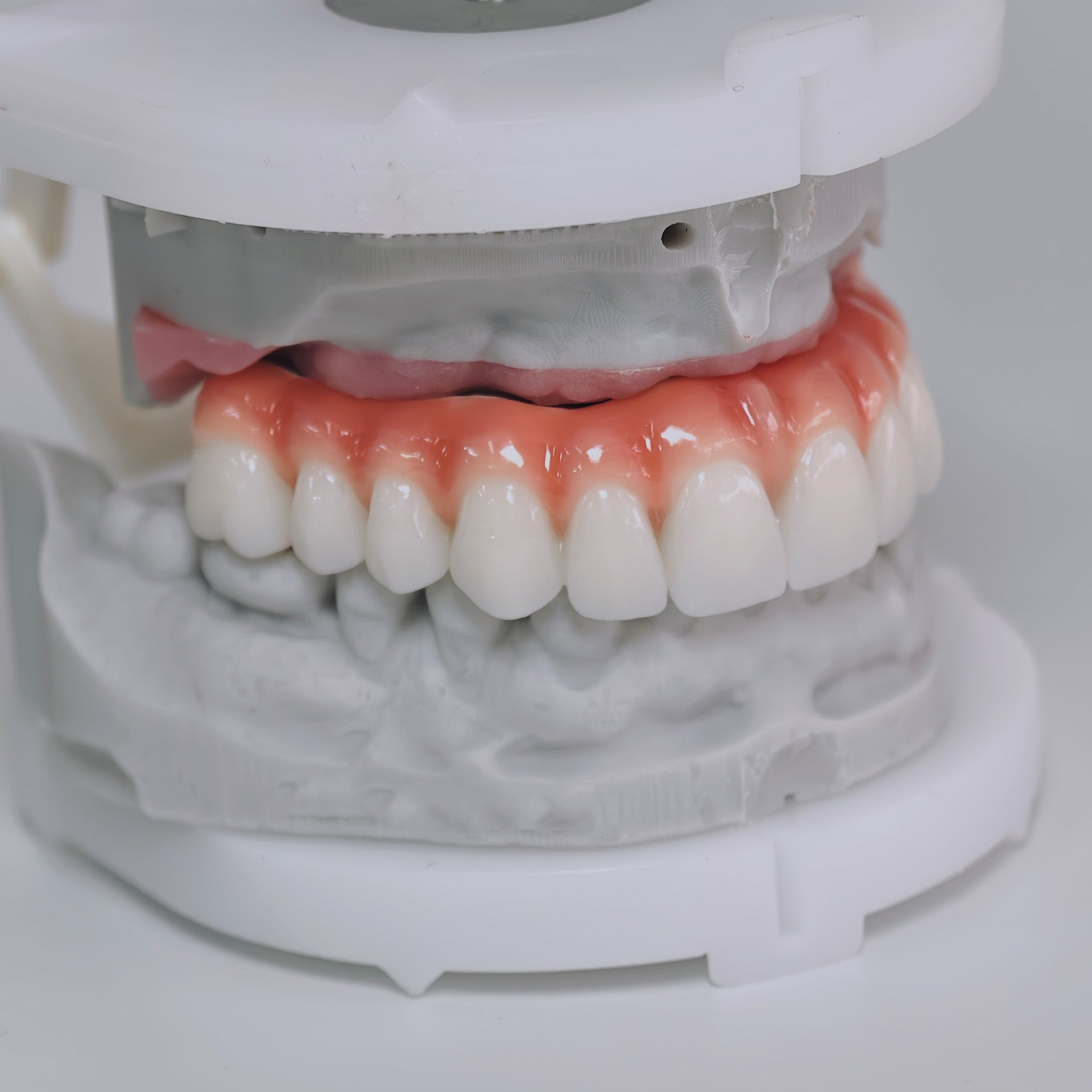 Zirconia-Enamel Hybrid Malo Bridge Aesthetic