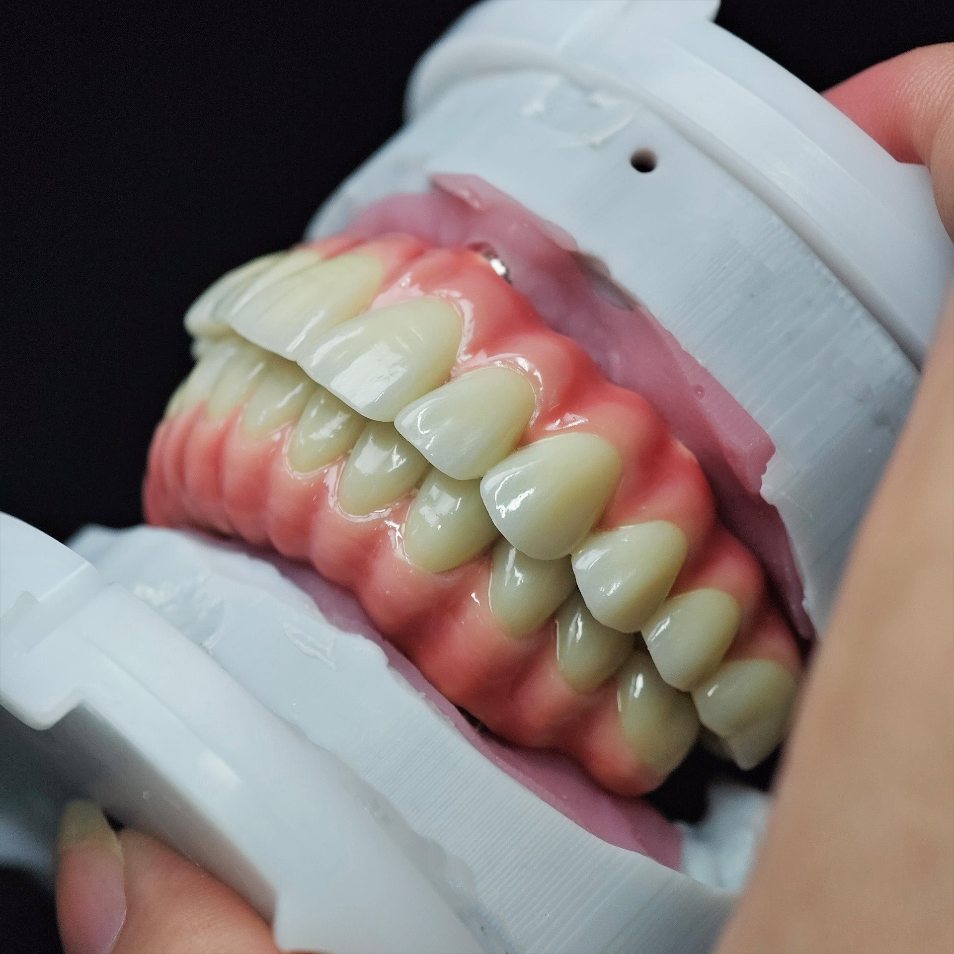 Zirconia-Enamel Hybrid Malo Bridge