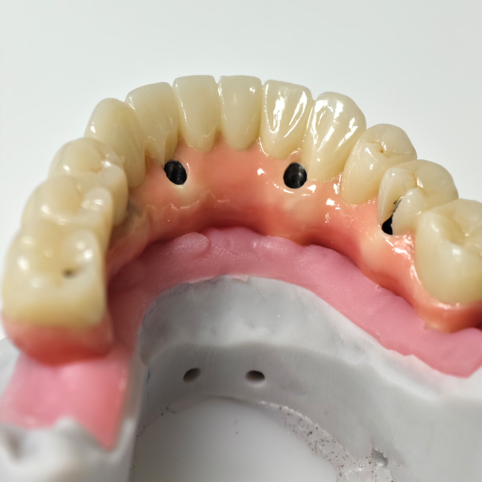 Zirconia-Enamel Hybrid Malo Bridge