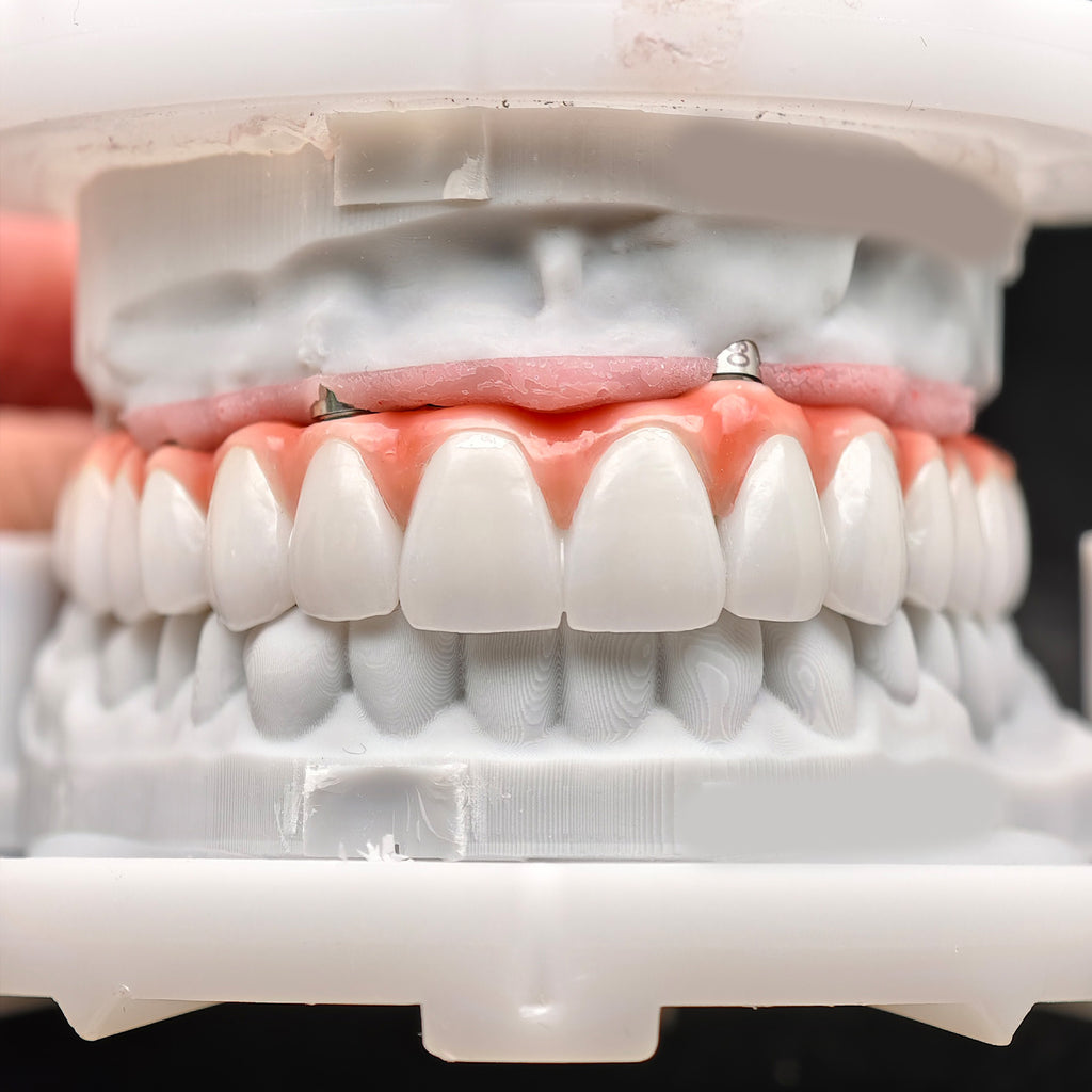 Zirconia-Enamel Hybrid Malo Bridge