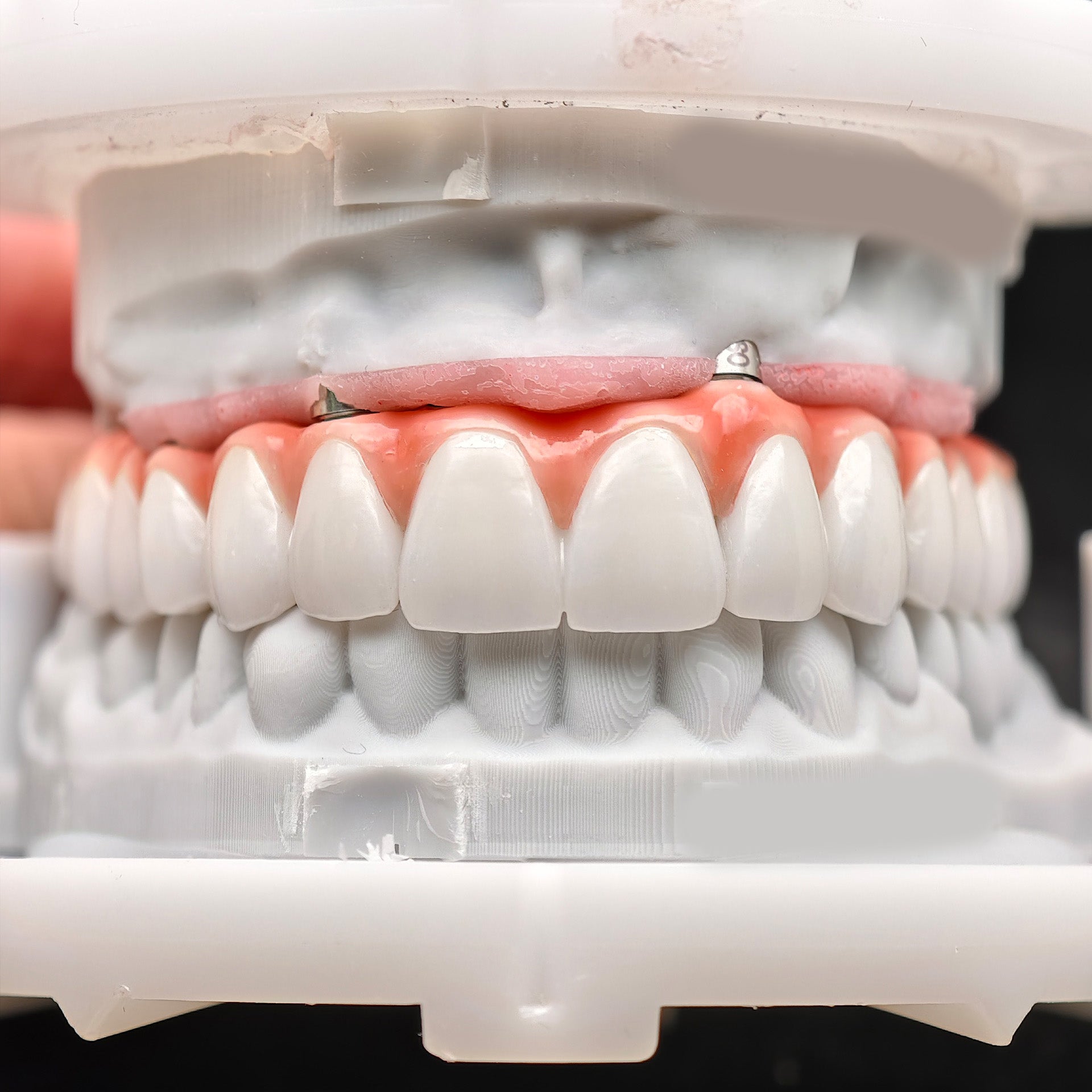 Zirconia-Enamel Hybrid Malo Bridge