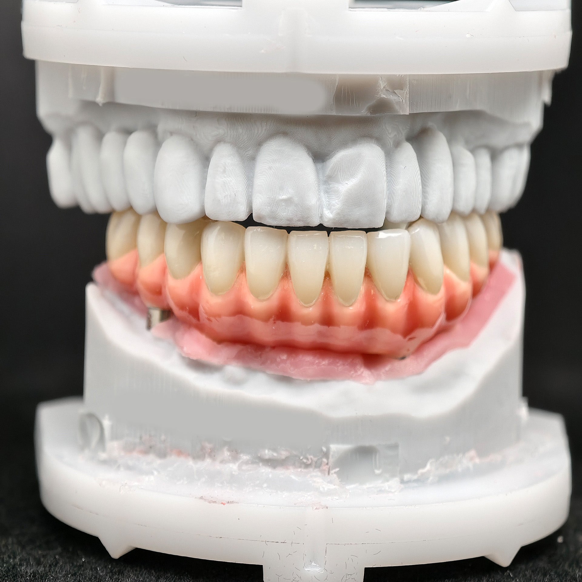 Zirconia-Enamel Hybrid Malo Bridge